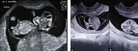 Anencephaly Ultrasound