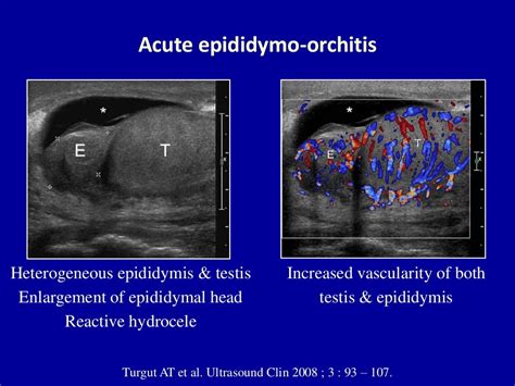 Doppler ultrasound of acute scrotum