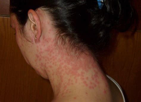 Browntail Moth Infestation and Rash - Get the Facts Now