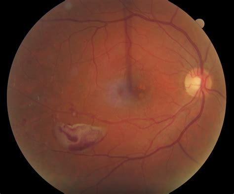 Diabetic Retinopathy - The Retina Centers of Washington