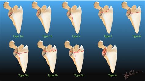 Ideberg Classification of Scapular Fractures | UW Emergency Radiology