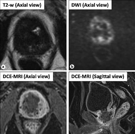 Prebiopsy MRI showed that the entire prostate was occupied by lesions ...