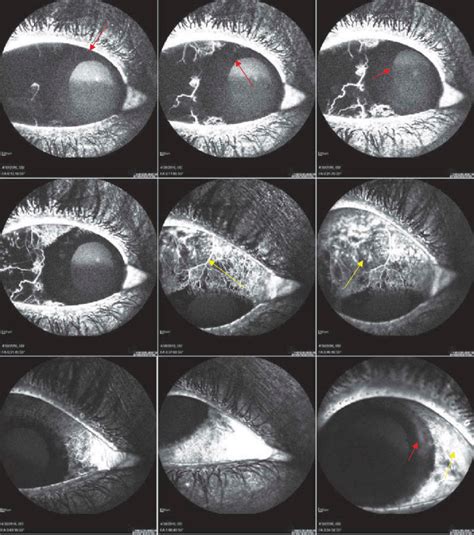 Fluorescein angiography findings in the right eye of the patient ...