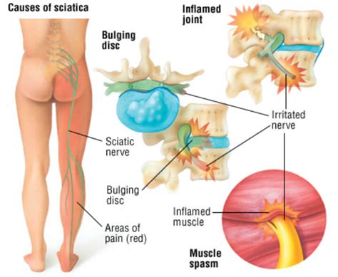 St. Louis Sciatica Pain Relief - Citrin Chiropractic Center