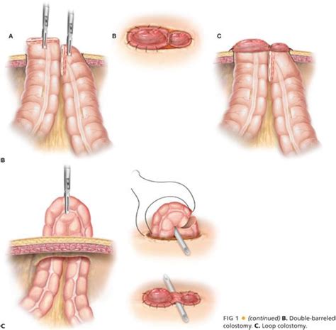 Laparoscopic Diverting Colostomies: Formation and Reversal | Abdominal Key