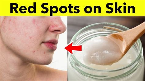 Casual Tips About How To Reduce Red Spots On Your Face - Effectsteak33