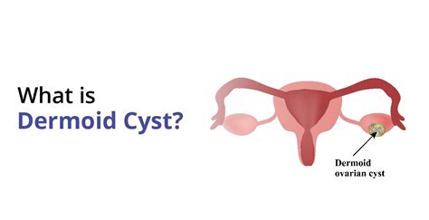 Dermoid Cyst: Types, Causes, Symptoms & Treatment | Birla Fertility & IVF