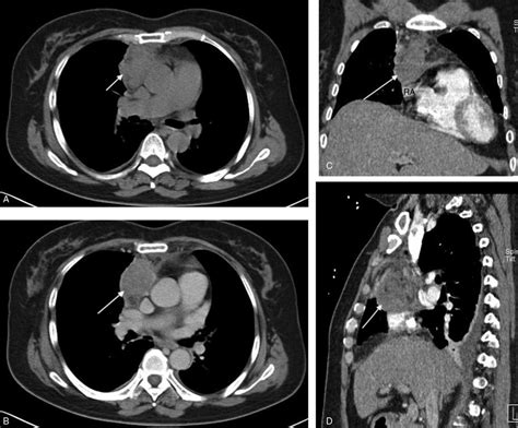 The CT scan of the mass (arrow) in the anterior mediastinum. (A) It is ...