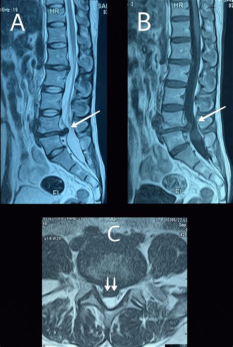 Cureus Herniating Intradural Disc At Lumbar L4-L5 Level: A