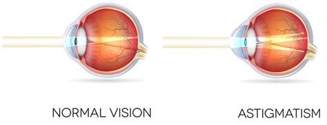 Astigmatism | What is it, Causes and Treatment