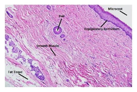 Ovarian dermoid histology (hematoxylin and eosin stain). | Download ...