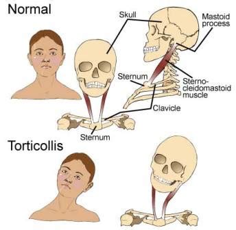 Torticollis:Causes,Symptoms,Types & Treatment » How To Relief