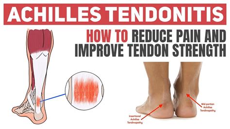 Achilles Tendonitis Exercises Worksheet | ubicaciondepersonas.cdmx.gob.mx