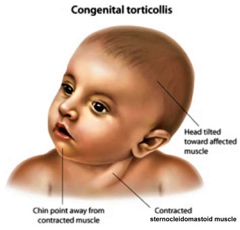 Torticollis in adults, spasmodic torticollis, infant torticollis causes ...