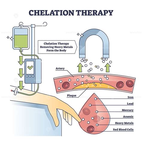 Chelation therapy for toxic heavy metal medical treatment outline ...