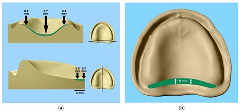 Materials | Free Full-Text | Misfit of Complete Maxillary Dentures ...