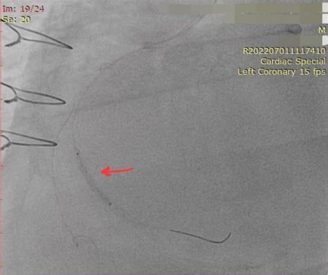 Management of In-stent Restenosis - Indian Journal of Cardiovascular ...