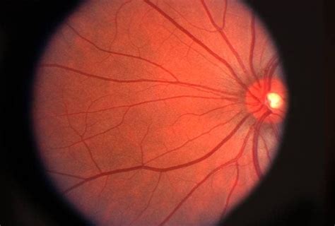 Retinal Diseases