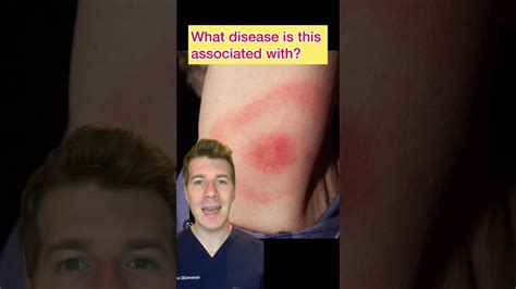 A bullseye rash following a camping trip… 🎯 what’s the diagnosis? # ...