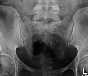 Imaging the Sacrum and Coccyx: Review of Technique in the Weight ...