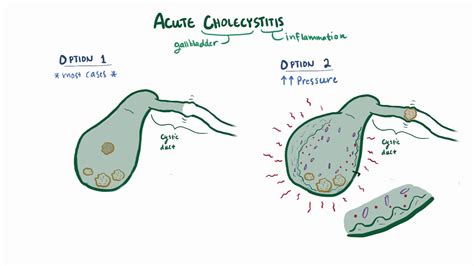 Acute cholecystitis causes, symptoms, diagnosis, treatment & pathology ...