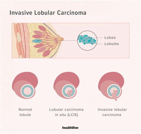 Invasive Breast Cancer: Types, Symptoms, Treatment, and Outlook