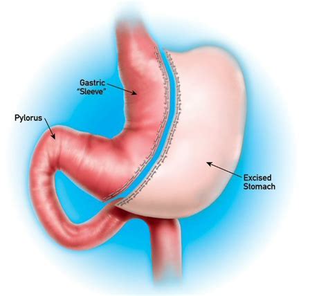 Complications of Sleeve Gastrectomy | Dr. Sharma's Obesity Notes