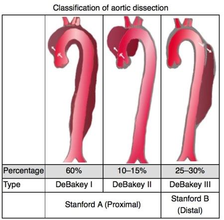 Acute Thoracic Aortic Dissection – EMCAGE