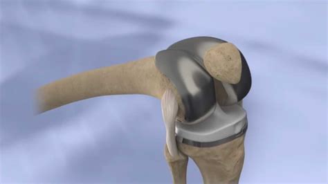 Pros and Cons of Knee Replacement - Adclays