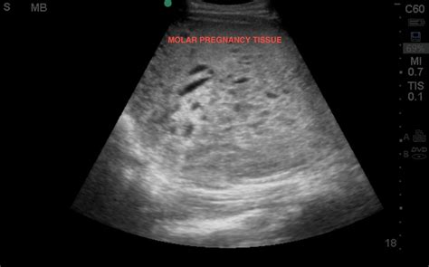 Molar Pregnancy Ultrasound – asnachicago