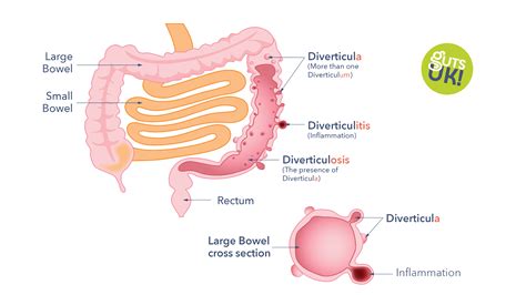 Diverticulitis Vs Diverticulosis