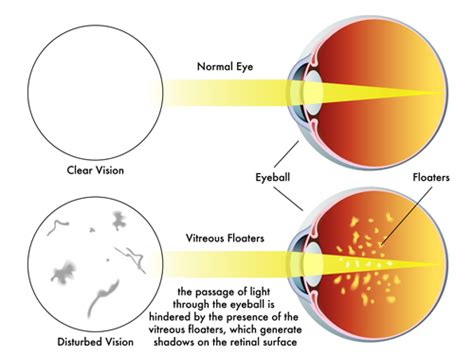 Eye Floaters: Treatment Of Vitreous Strands and Opacities - Your Health ...