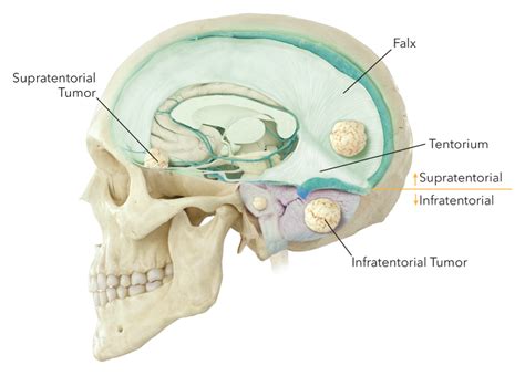 Common Brain Tumor Locations | Expert Surgeon | Aaron Cohen-Gadol, MD