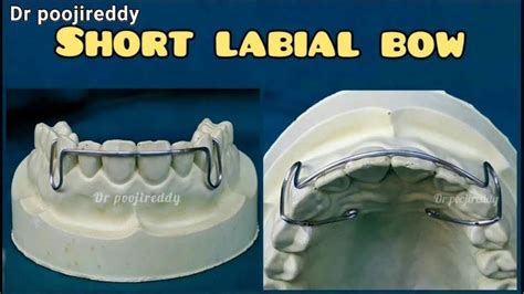 Short labial bow fabrication |short labial bow dentistry orthodontics ...