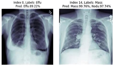 Healthy Lungs Vs Smokers Lungs X Ray