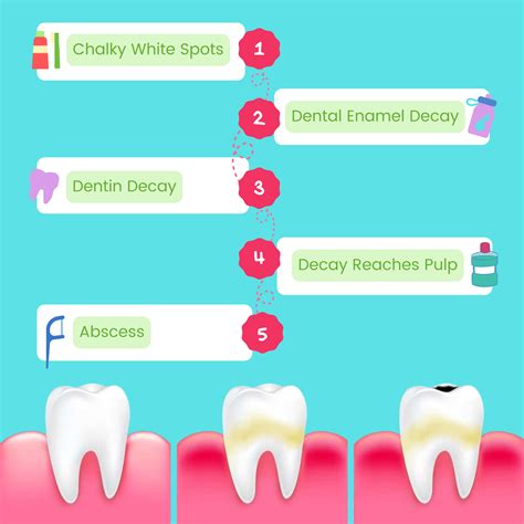 The Stages of Tooth Decay - Willow Dental