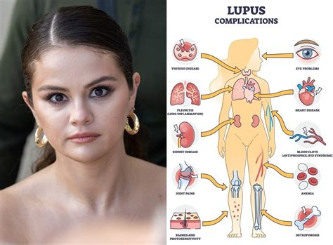 Selena Gomez: Plastic Surgery or Lupus? Why Fans are Wrong