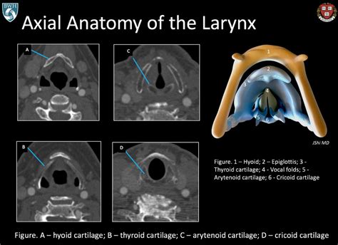 Epiglottis Ct Anatomy