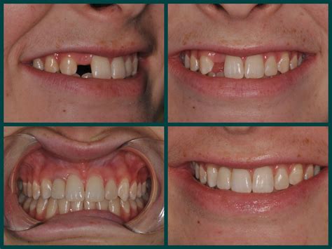 Smile Spotlight: Erin | Restore Missing Tooth with Dental Implant & Crown