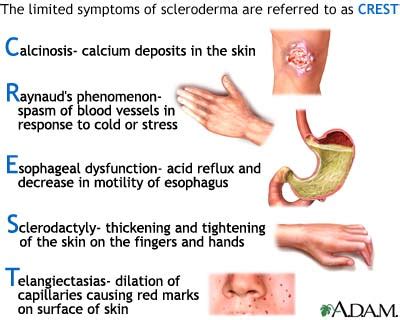 Systemic Sclerosis (scleroderma) - MDNotes