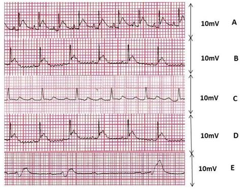 Typical ECG tracings showing various arrhymic effect of digoxin (20 ...