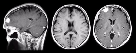 Meningioma Brain Tumor - Causes, Symptoms, Survival Rate, Treatment