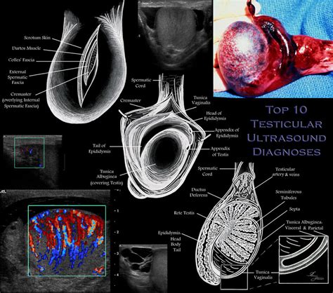 Scrotal Anatomy Ultrasound