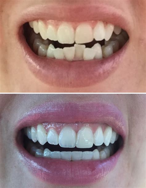 Franish: my experience with invisalign