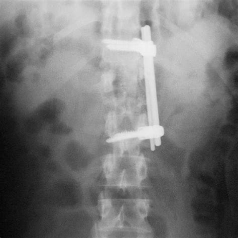 (PDF) Total L1 Vertebrectomy With T12-to-L2 Fusion in a Case of Burst ...