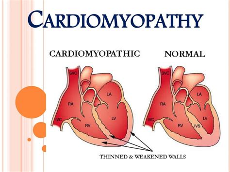 PPT - Heart Muscle Disease (Cardiomyopathy) PowerPoint Presentation ...