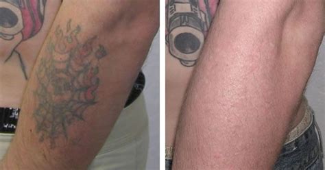 dermabrasion tattoo removal before and after - diers-annon