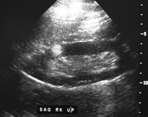 Renal Cell Carcinoma Ultrasound | Kidney