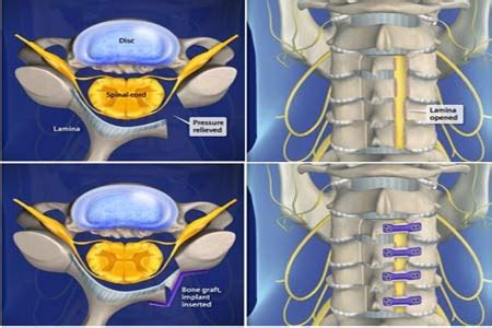 Comparison of Laminoplasty vs. Laminectomy