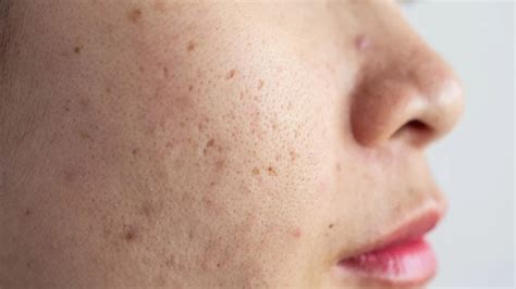 Hyperpigmentation acne: Causes and treatment